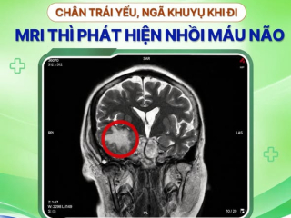  CHÂN TRÁI YẾU, ĐI LẠI NGÃ KHUỴU – ĐỪNG NGHĨ CHỈ LÀ TUỔI GIÀ 