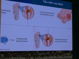 GS.TS.BS Nguyễn Đức Công chia sẻ về bệnh GOUT